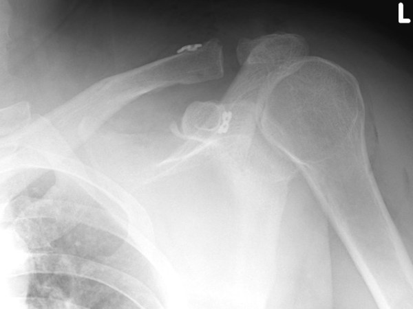 Première ligamentoplastie coraco claviculaire à l’hôpital Français&nbsp;d’Hanoï
