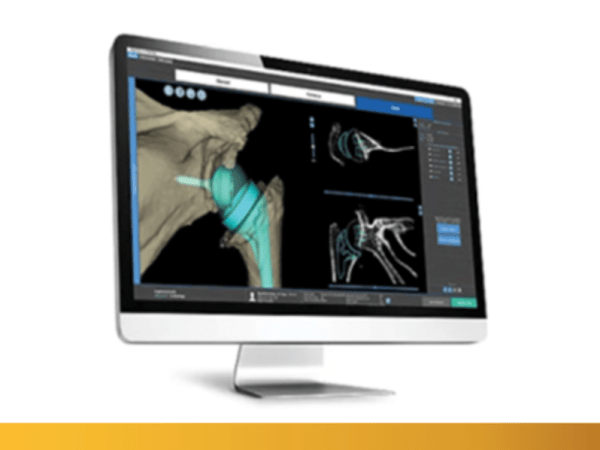 Prothèse d&rsquo;épaule : planification pré&nbsp;opératoire