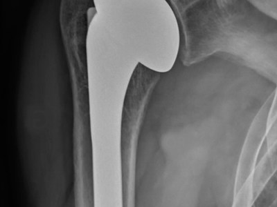 Prothèse Totale Anatomique d’Épaule : &laquo;&nbsp;Une Solution Naturelle&nbsp;&raquo;
